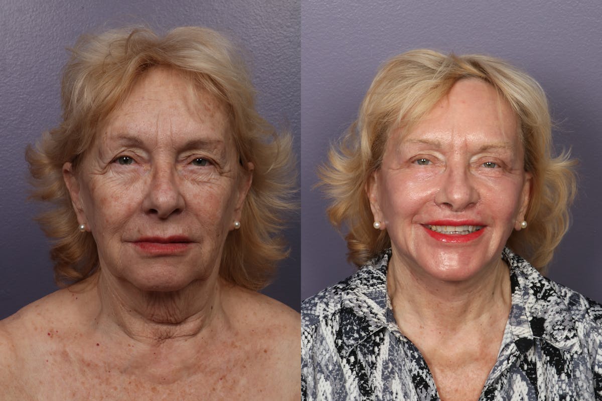 Facial Fat Transfer Before & After Gallery - Patient 207825 - Image 3