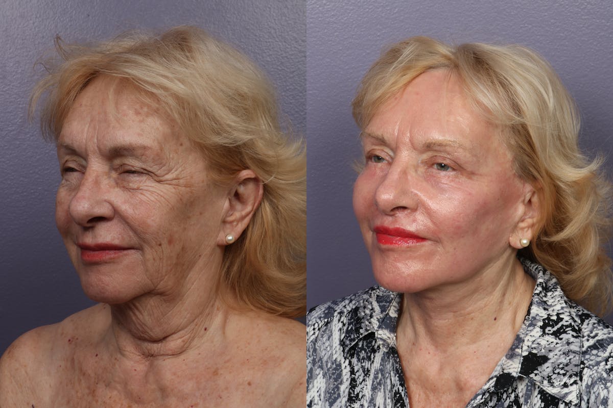 Facelift Before & After Gallery - Patient 387207 - Image 1