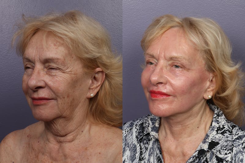 Facelift Before & After Gallery - Patient 387207 - Image 1