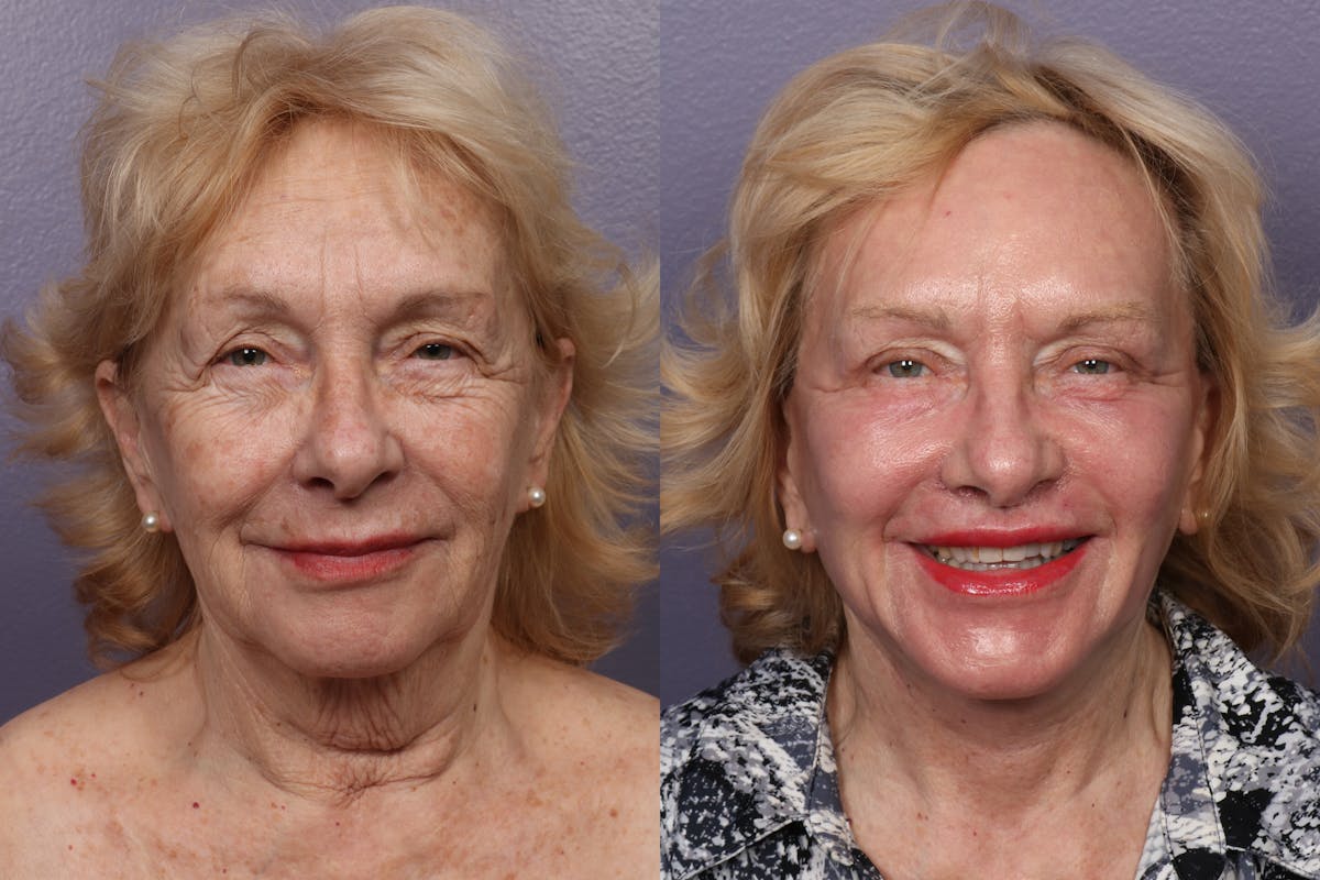 Facelift Before & After Gallery - Patient 387207 - Image 4