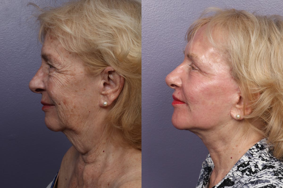Neck Lift Before & After Gallery - Patient 318576 - Image 1
