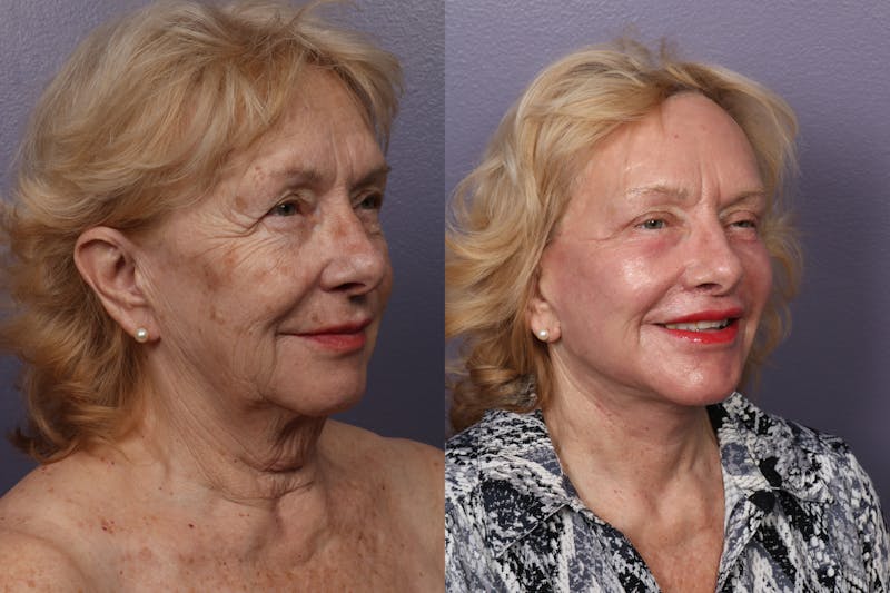 Patient Y6O8YB9FRtCHqy7M2oktAQ - Facial Fat Transfer Before & After Photos