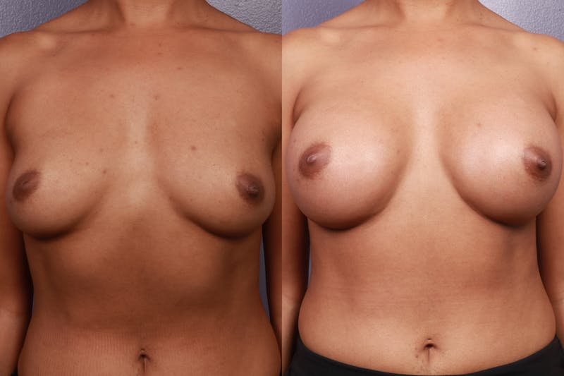 Patient TwRugLppQPKd94nwbTBekg - Breast Augmentation Before & After Photos