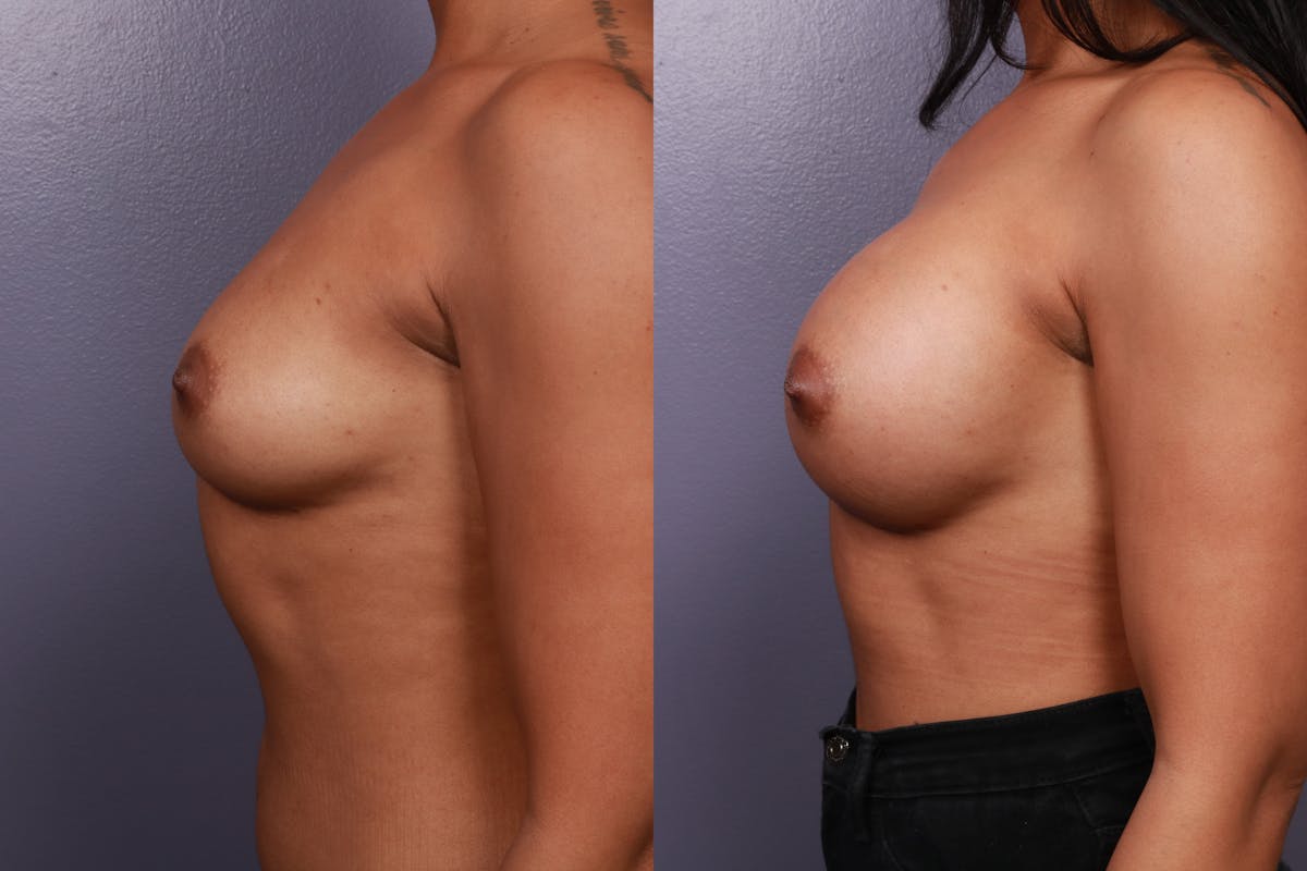 Breast Augmentation Before & After Gallery - Patient 599316 - Image 2
