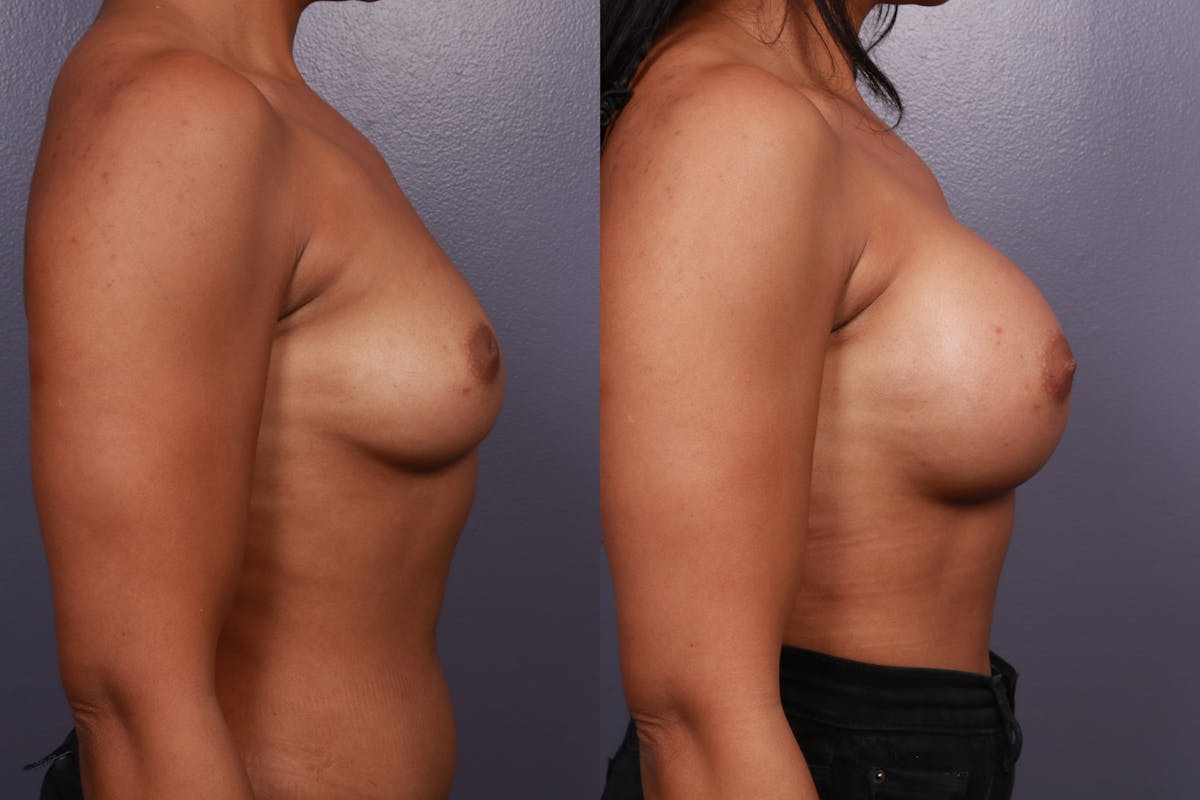 Breast Augmentation Before & After Gallery - Patient 599316 - Image 3