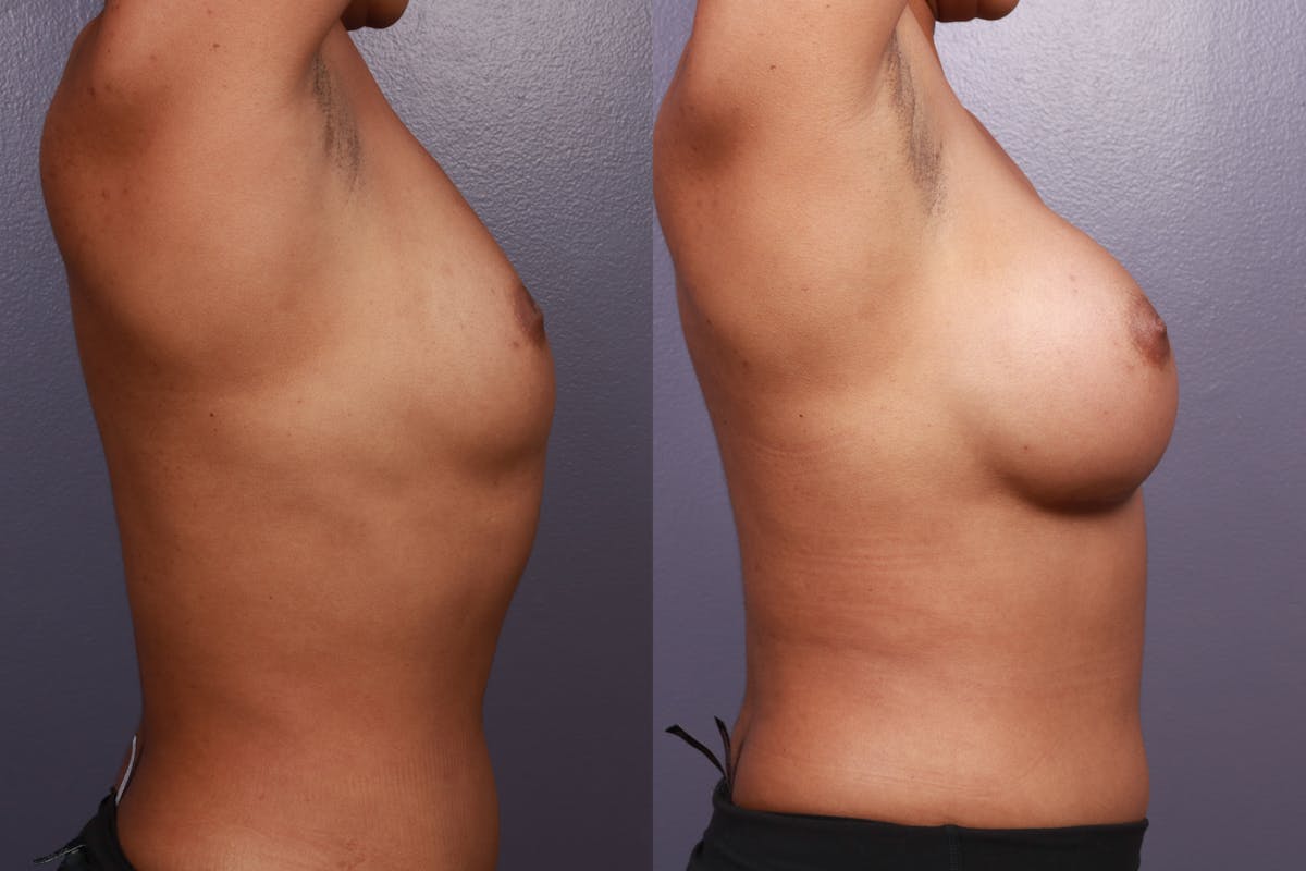 Breast Augmentation Before & After Gallery - Patient 599316 - Image 4