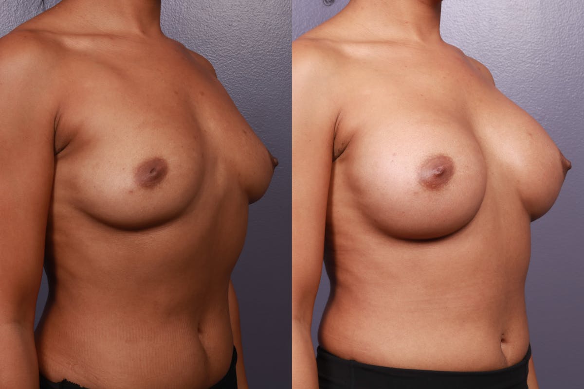 Breast Augmentation Before & After Gallery - Patient 599316 - Image 5