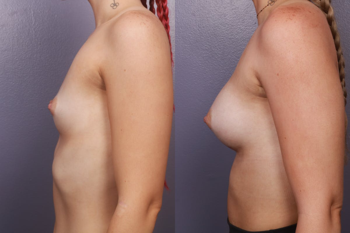 Breast Augmentation Before & After Gallery - Patient 414509 - Image 3