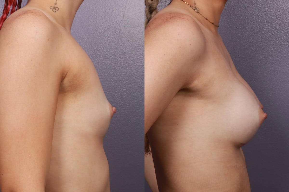 Breast Augmentation Before & After Gallery - Patient 414509 - Image 5