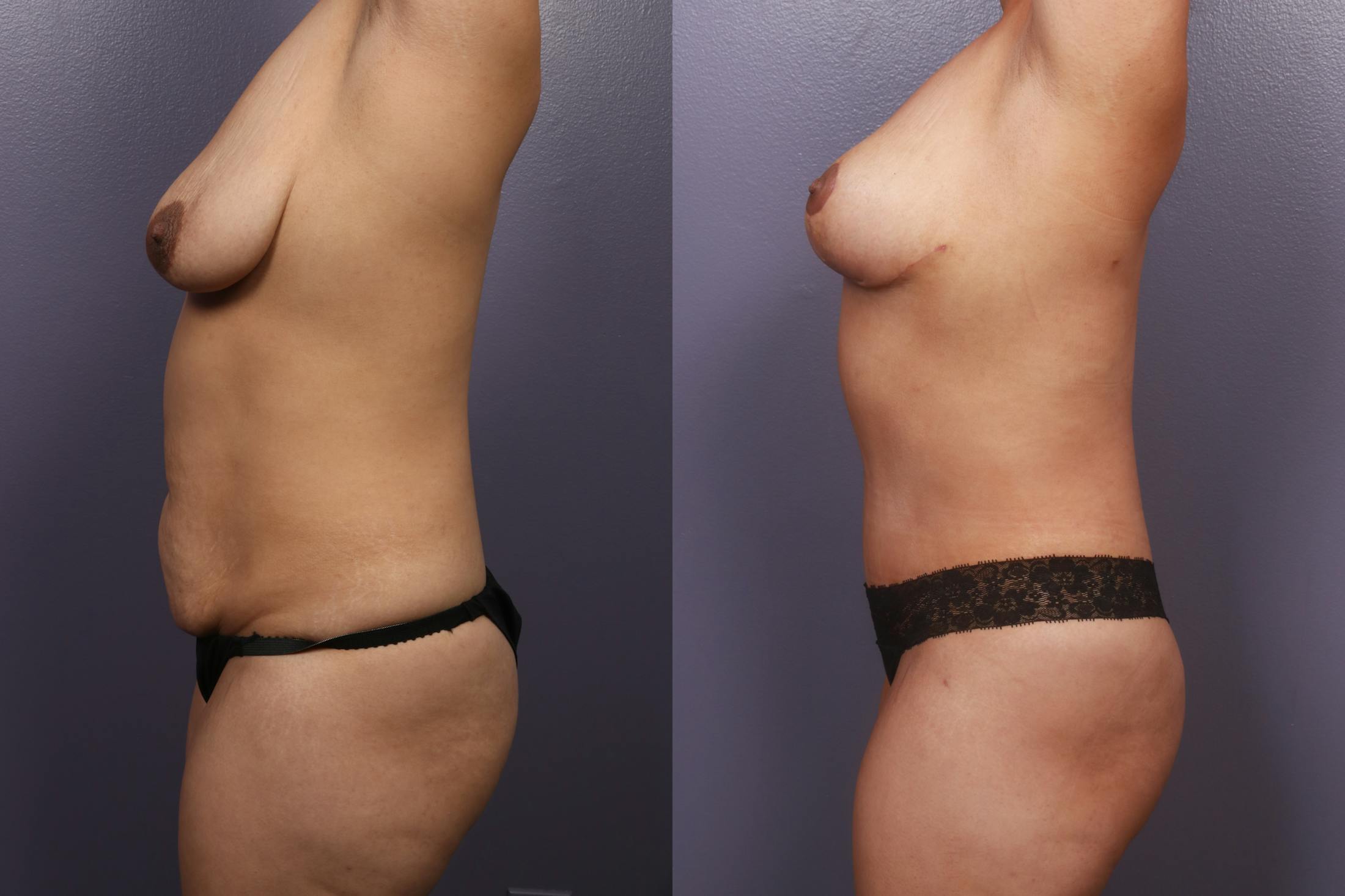 Mommy Makeover Before & After Gallery - Patient 203238 - Image 3