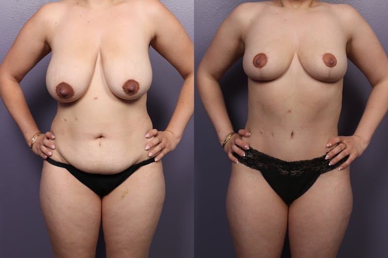 Mommy Makeover Before & After Gallery - Patient 337449 - Image 1