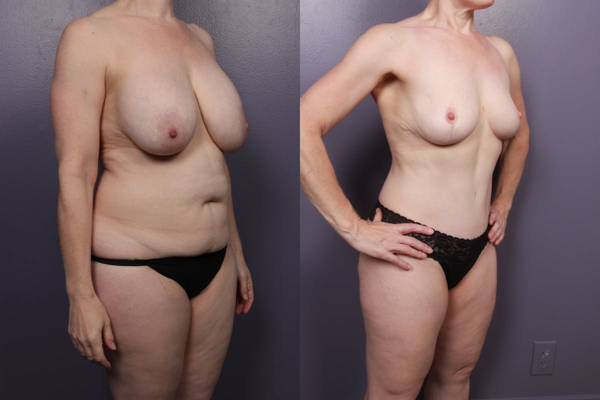Mommy Makeover Before & After Gallery - Patient 182763 - Image 2