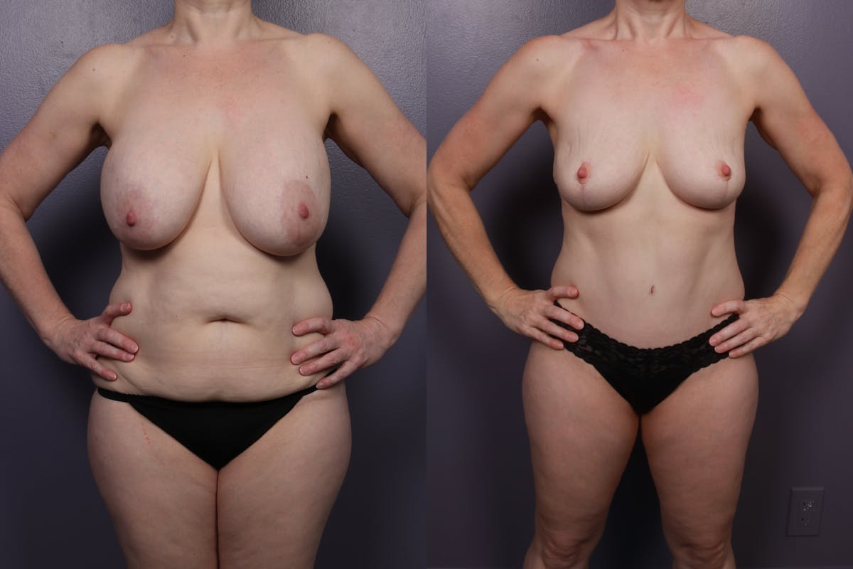 Mommy Makeover Before & After Gallery - Patient 182763 - Image 1