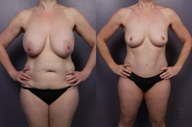 Patient aW-LnpQ5SKqkjS5OuNtnaQ - Mommy Makeover Before & After Photos