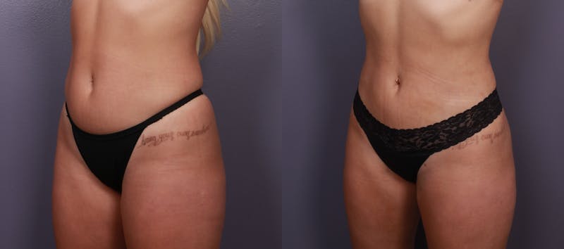 Liposuction Before & After Gallery - Patient 255250 - Image 1