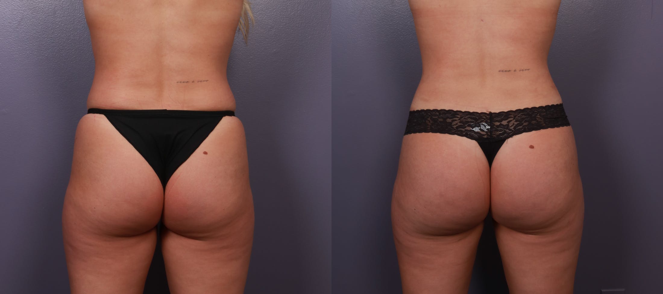Brazilian Butt Lift Before & After Gallery - Patient 351925 - Image 2