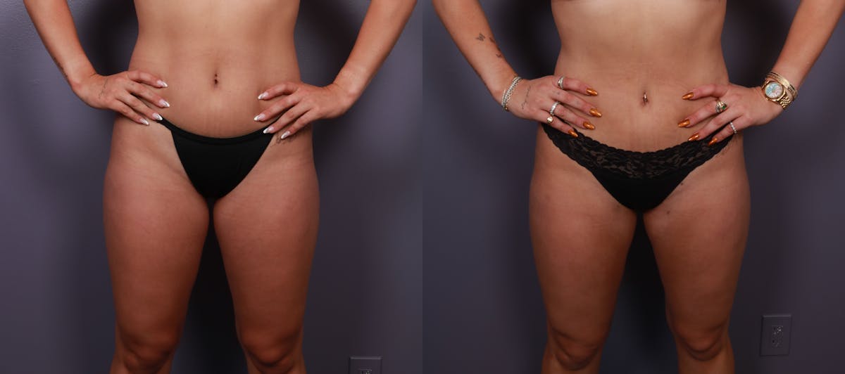 Liposuction Before & After Gallery - Patient 255250 - Image 2