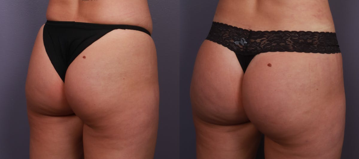 Liposuction Before & After Gallery - Patient 255250 - Image 5