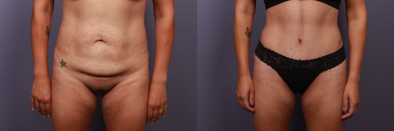 Patient BxxgSVJBQlq2LZEhoGjsxQ - Tummy Tuck Before & After Photos