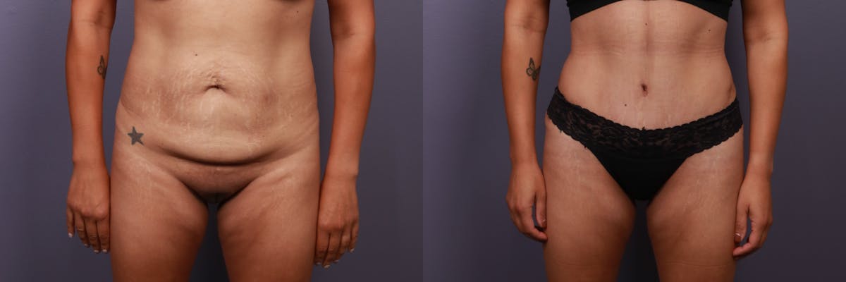 Abdominoplasty Before & After Gallery - Patient 282207 - Image 1