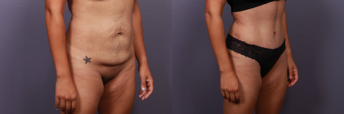 Abdominoplasty Before & After Gallery - Patient 282207 - Image 4