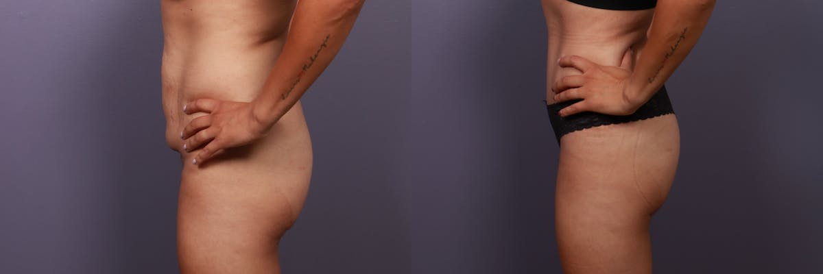 Abdominoplasty Before & After Gallery - Patient 282207 - Image 5