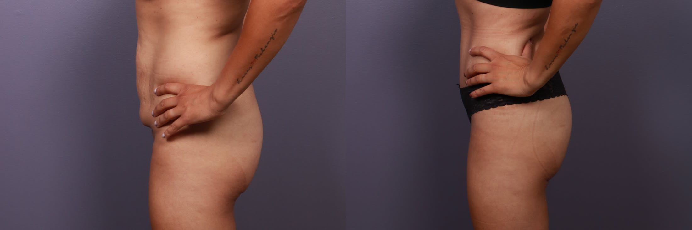 Abdominoplasty Before & After Gallery - Patient 282207 - Image 5