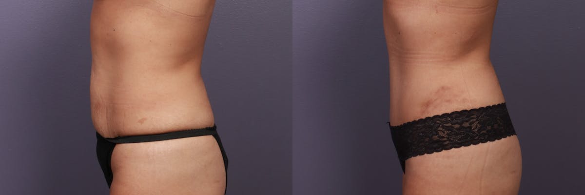 Abdominoplasty Before & After Gallery - Patient 282207 - Image 6