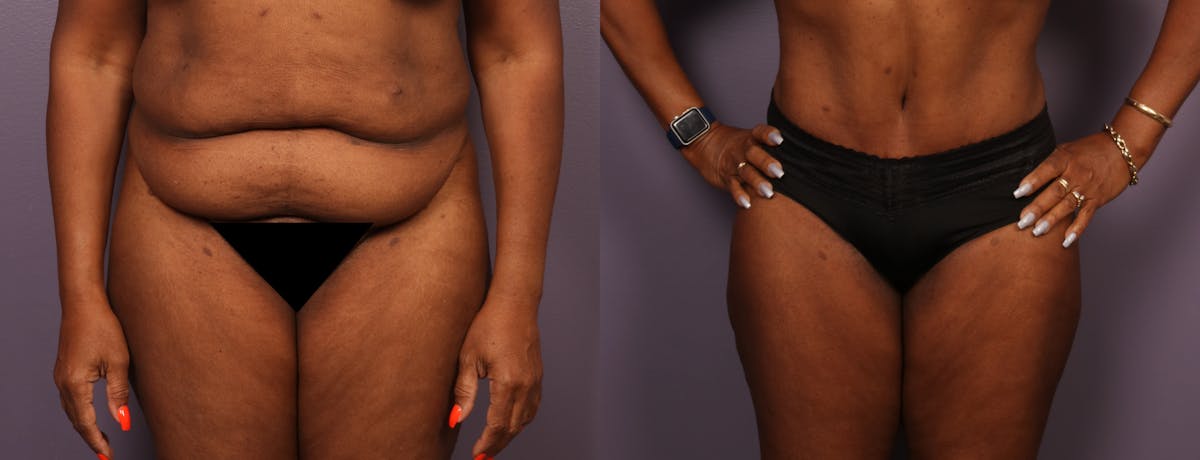 Abdominoplasty Before & After Gallery - Patient 925850 - Image 1