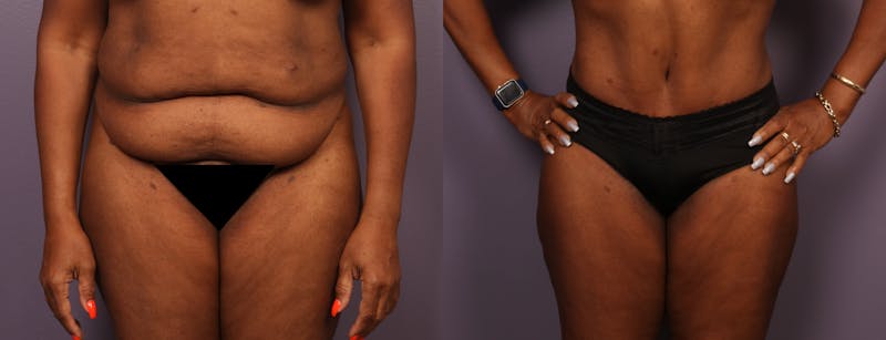 Abdominoplasty Before & After Gallery - Patient 925850 - Image 1