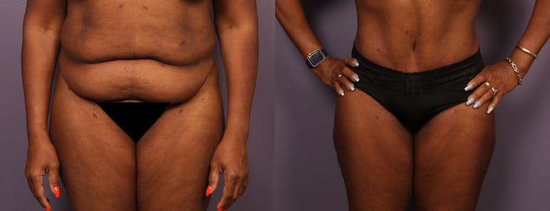 Patient V5qwxa1zSLKpJiZDXzslHw - Tummy Tuck Before & After Photos