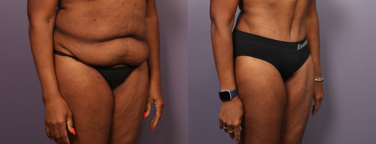 Abdominoplasty Before & After Gallery - Patient 925850 - Image 3