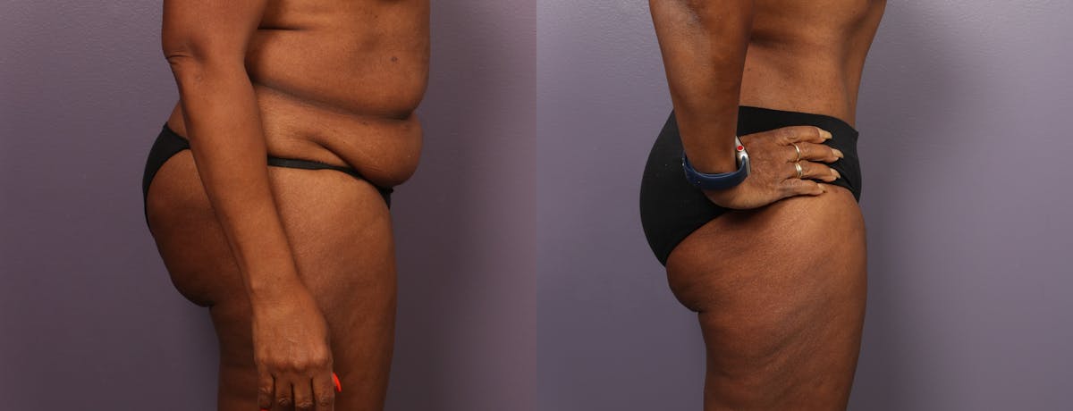 Abdominoplasty Before & After Gallery - Patient 925850 - Image 5