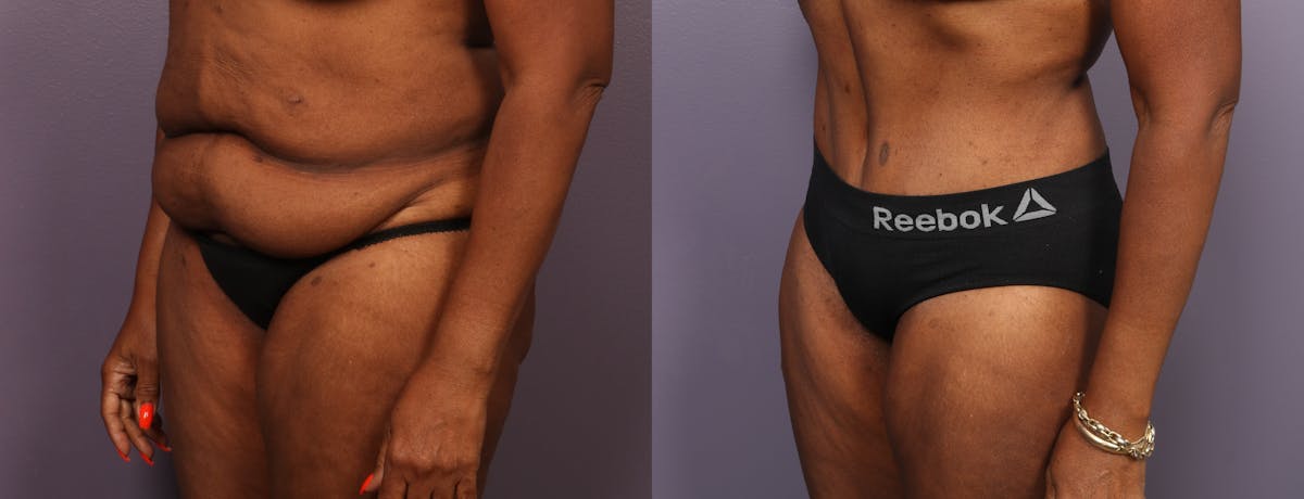 Abdominoplasty Before & After Gallery - Patient 925850 - Image 4