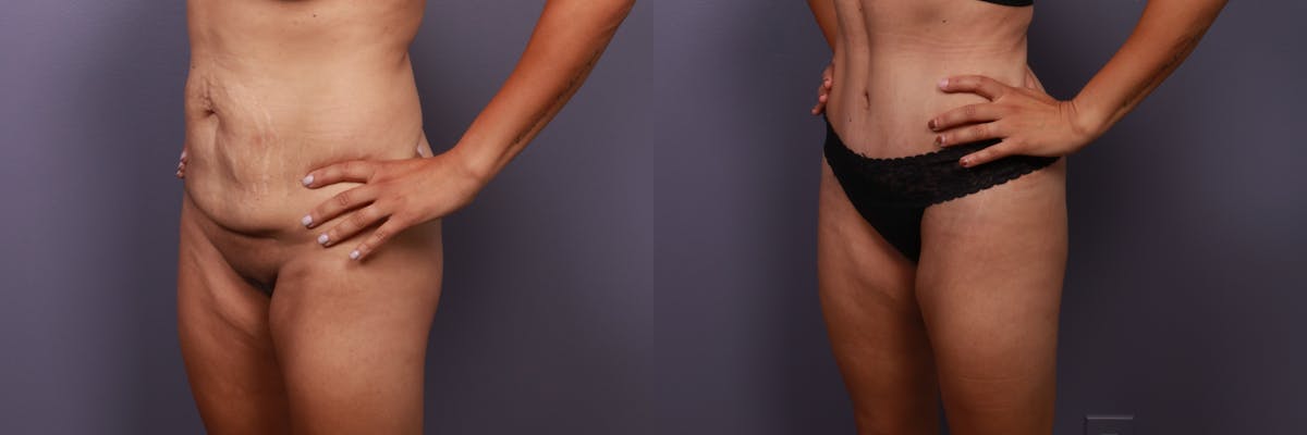Abdominoplasty Before & After Gallery - Patient 282207 - Image 2