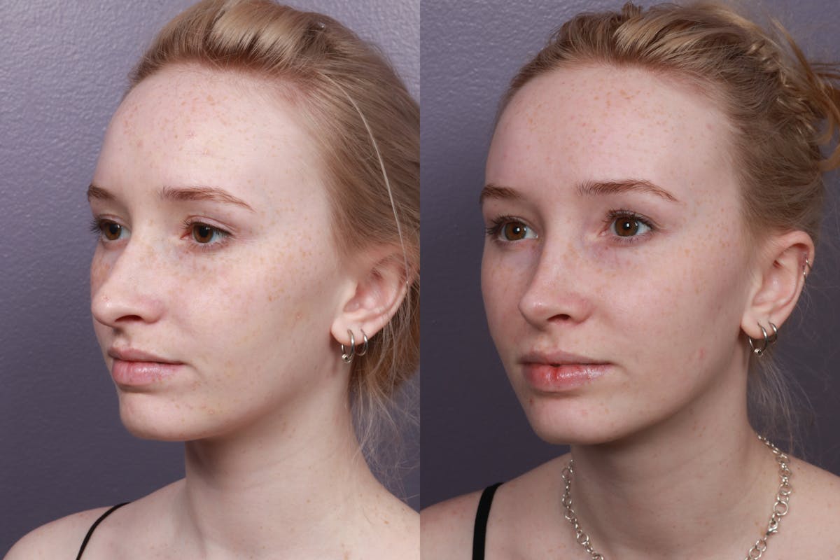 Rhinoplasty Before & After Gallery - Patient 375258 - Image 2