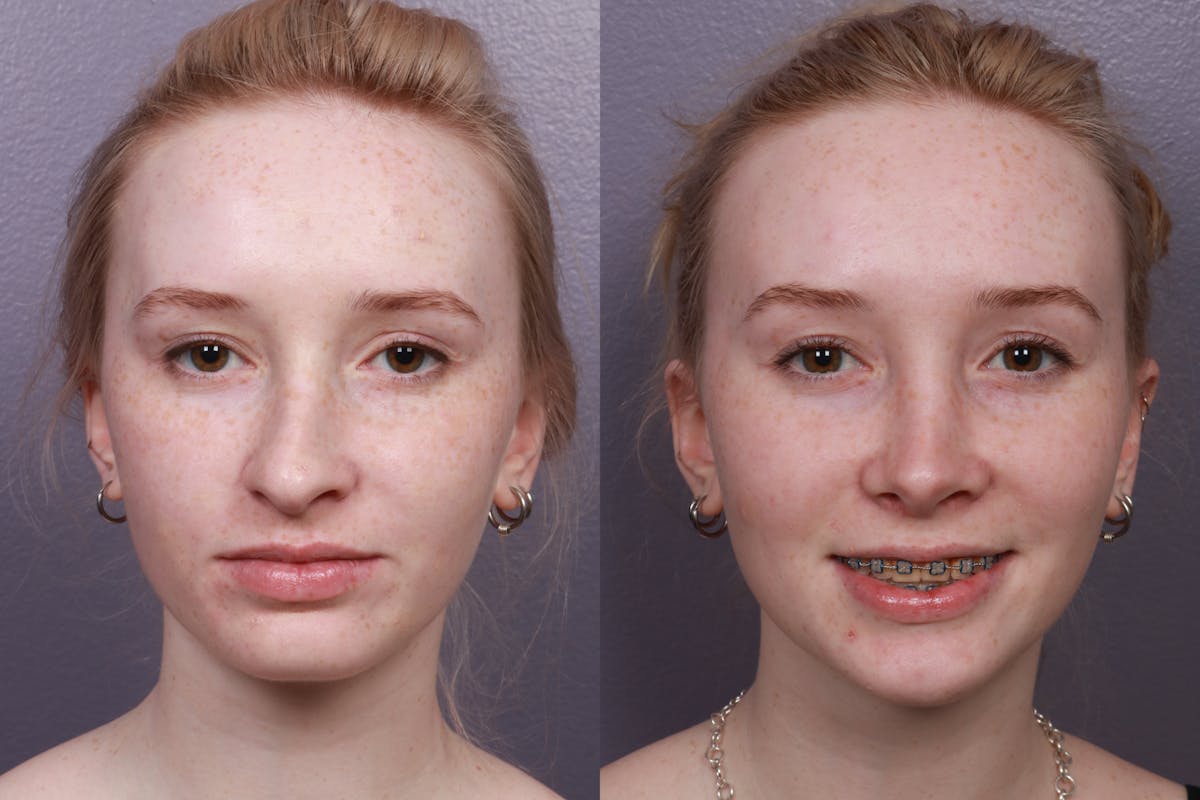 Rhinoplasty Before & After Gallery - Patient 375258 - Image 3