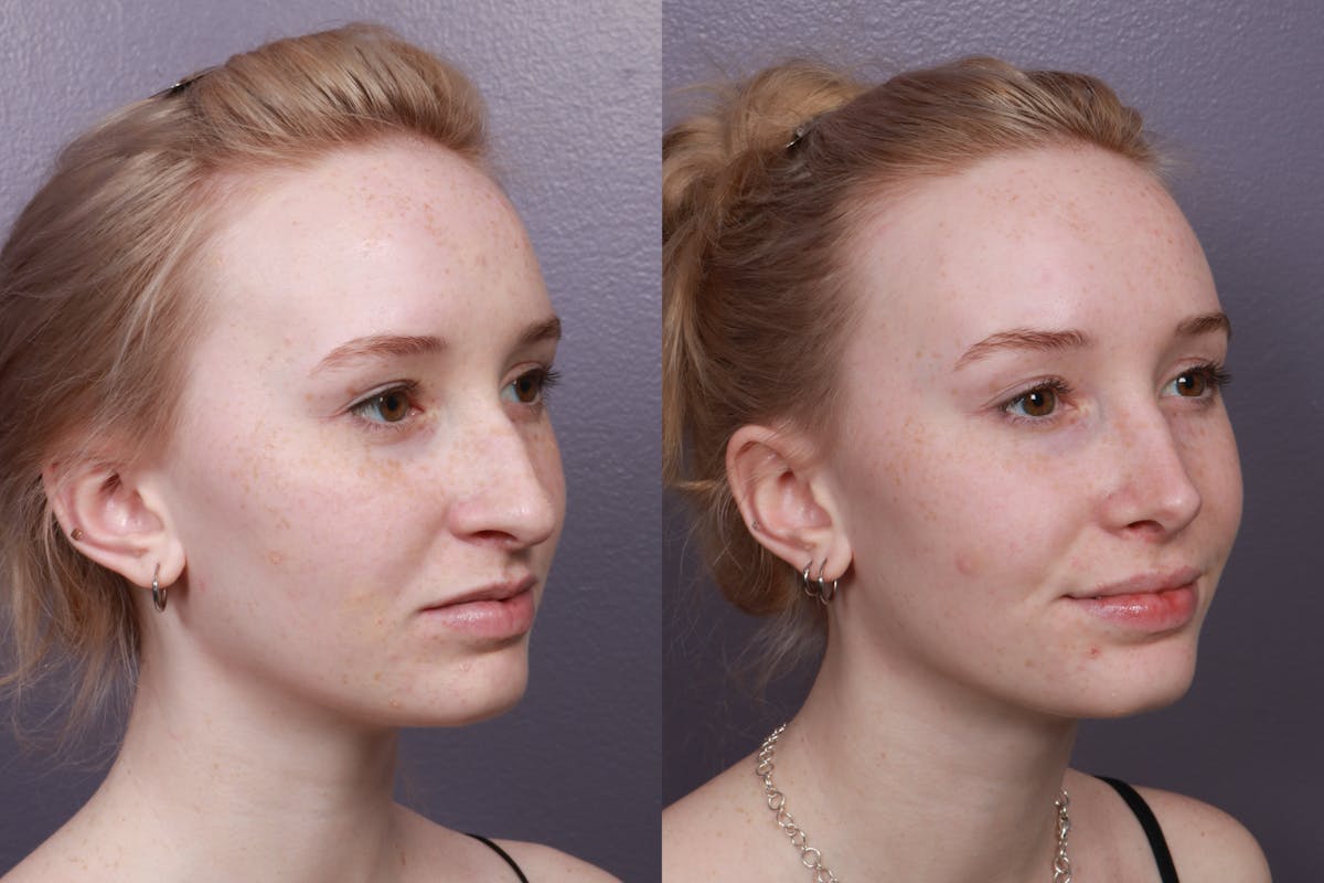 Rhinoplasty Before & After Gallery - Patient 375258 - Image 1