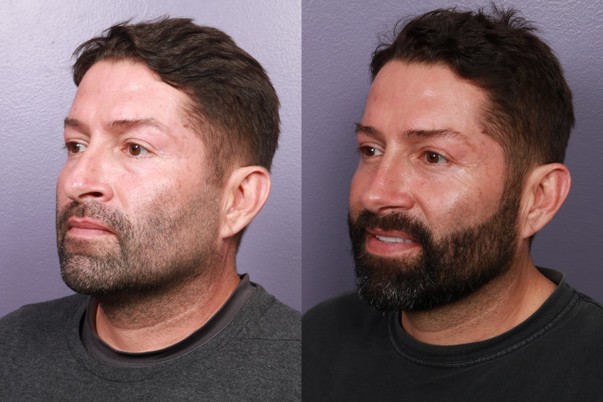 Rhinoplasty Before & After Gallery - Patient 350529 - Image 1