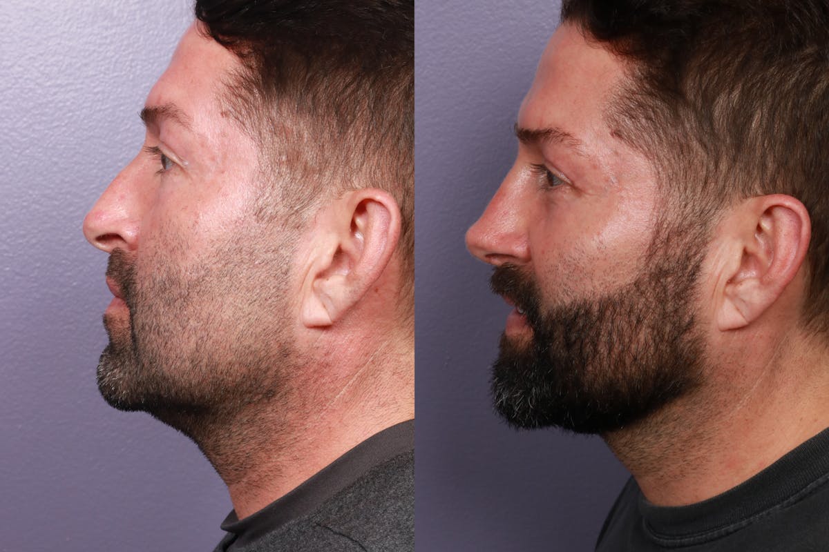 Rhinoplasty Before & After Gallery - Patient 350529 - Image 3