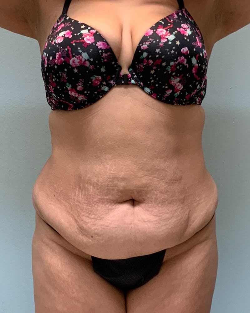 Body Lift Before & After Gallery - Patient 214225 - Image 1