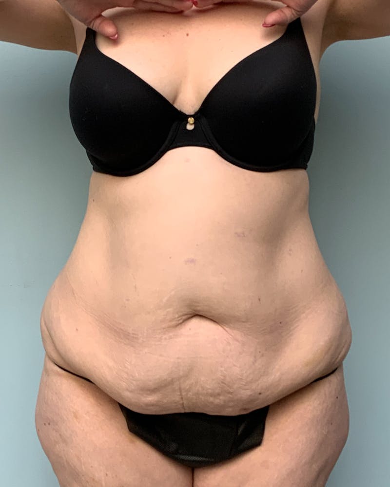 Body Lift Before & After Gallery - Patient 254176 - Image 1