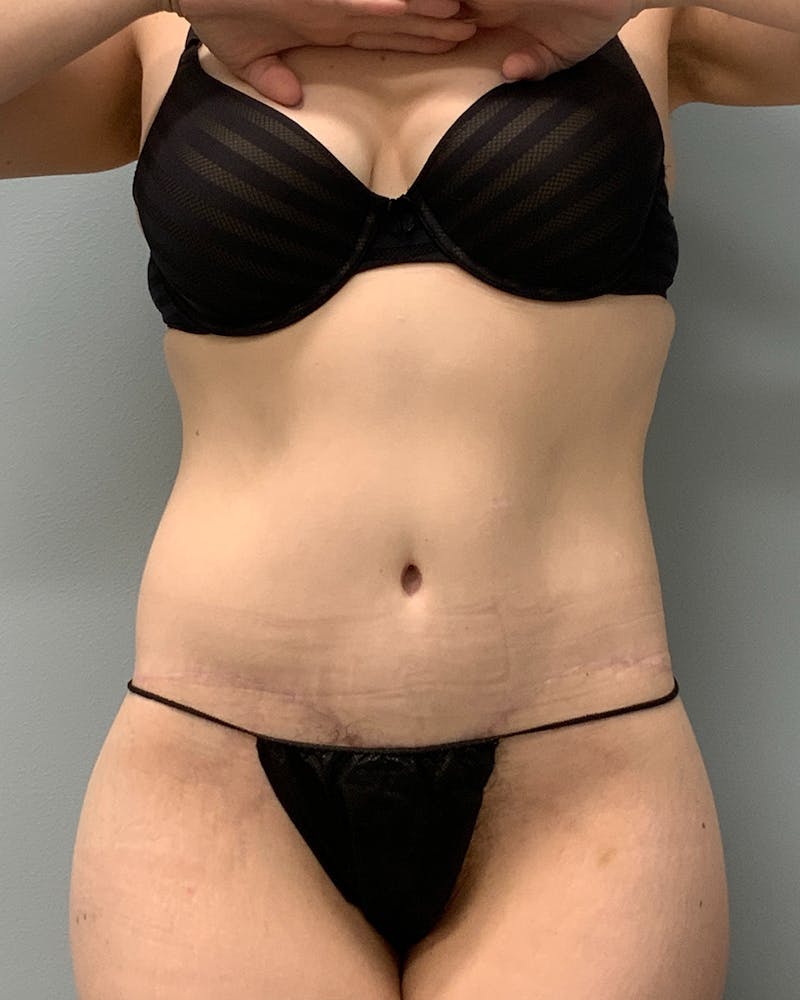 Body Lift Before & After Gallery - Patient 254176 - Image 2