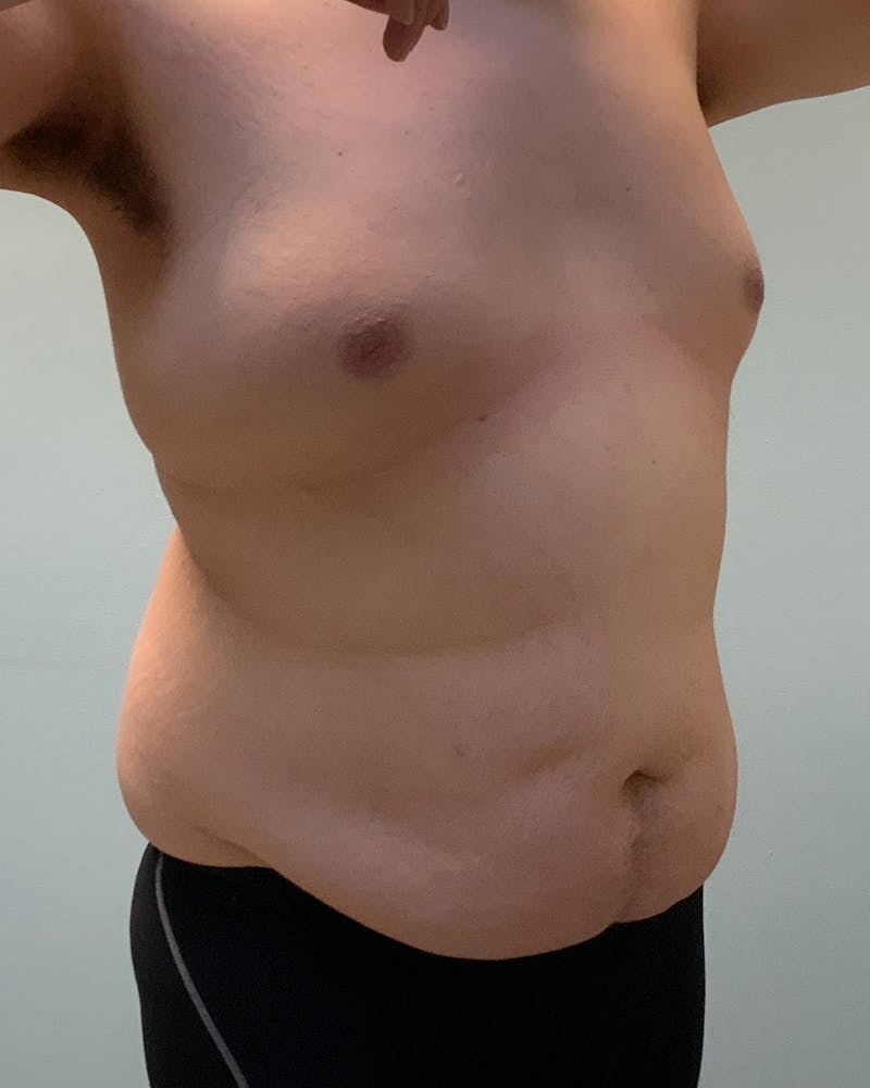 Body Lift Before & After Gallery - Patient 240327 - Image 1
