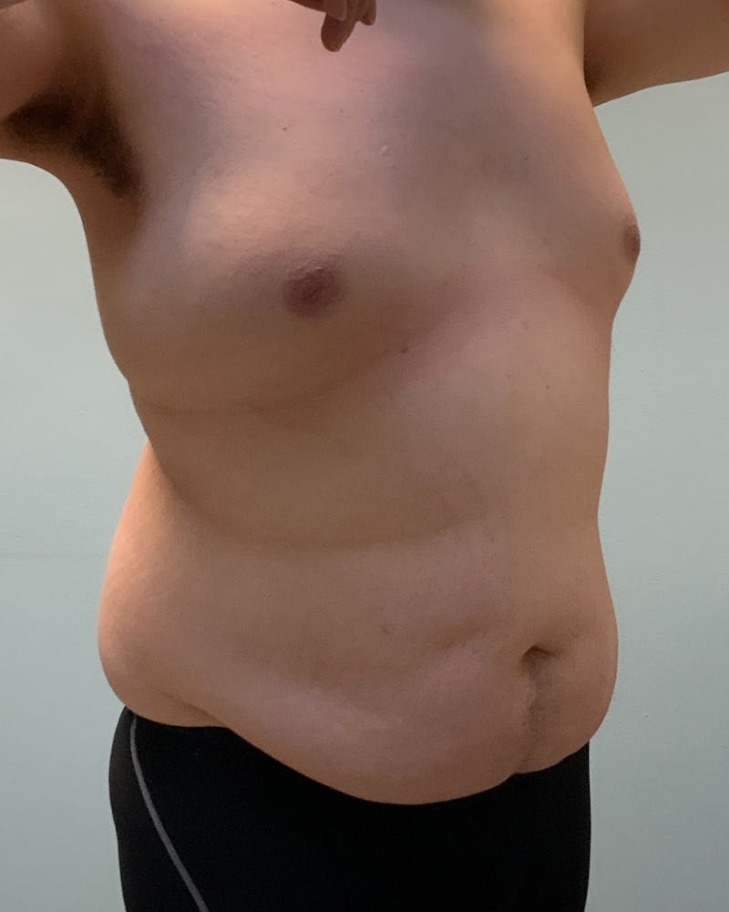 Patient Mwqkj12cTauswPtuxUWJXg - Body Lift Before & After Photos