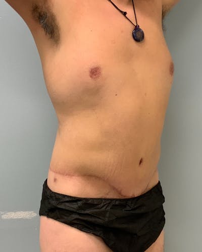 Body Lift Before & After Gallery - Patient 227046 - Image 2