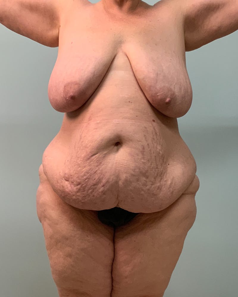Body Lift Before & After Gallery - Patient 743184 - Image 1