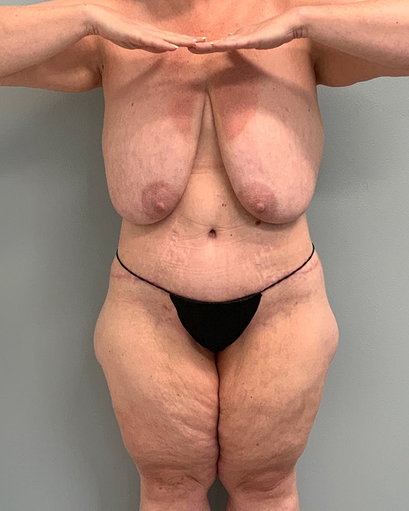 Body Lift Before & After Gallery - Patient 743184 - Image 2