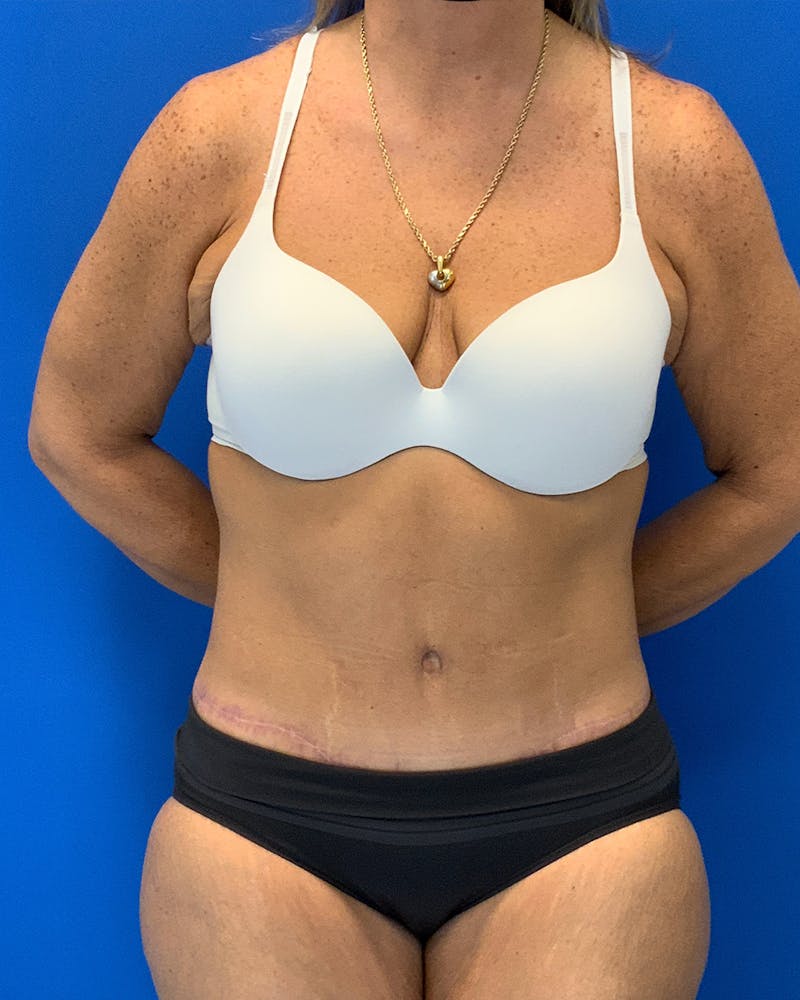Body Lift Before & After Gallery - Patient 337975 - Image 2