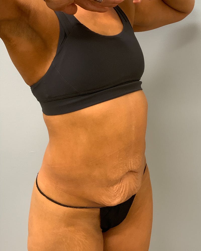 Body Lift Before & After Gallery - Patient 352296 - Image 1